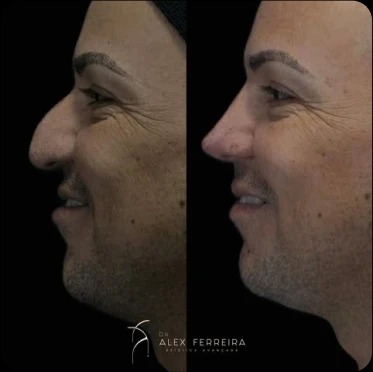 Resultado facial_5